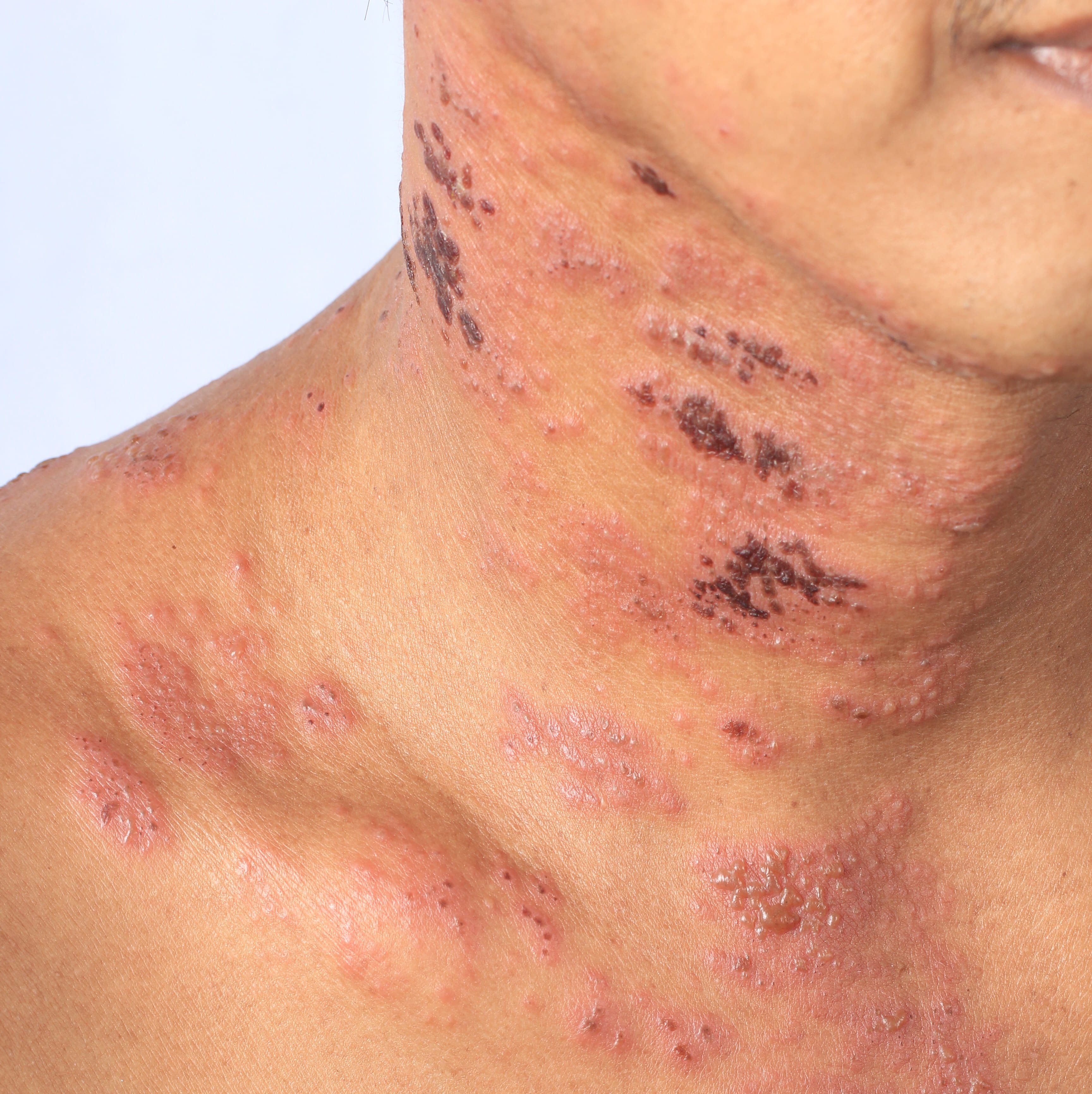 Herpes Zoster